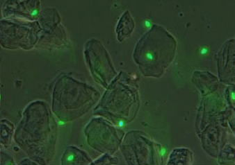 Mélange de spermatozoïdeset de cellules vaginales en microscopie à fluorescence, échantillon provenant d'un prélèvement de trace suspecte présente sur une petite culotte.